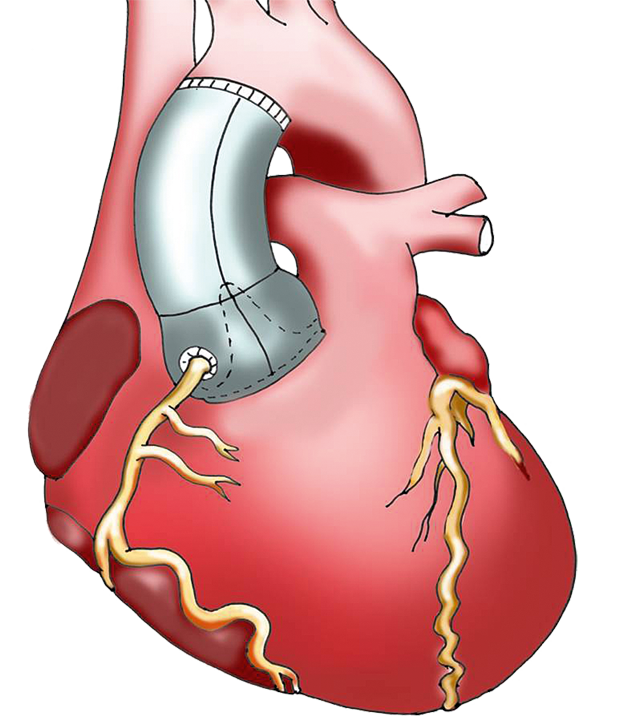 Aortenchirurgie Umg